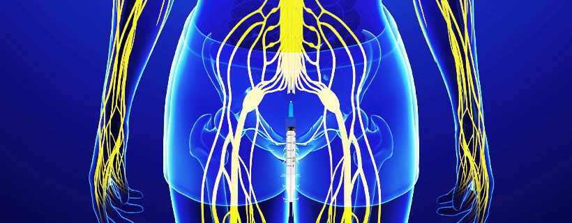 patient receiving Caudal Epidural Steroid Injections in Coppell for auto accident injury pain relief