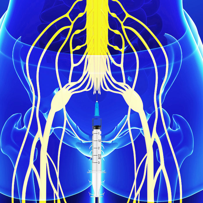 caudal epidural steroid injections in Coppell