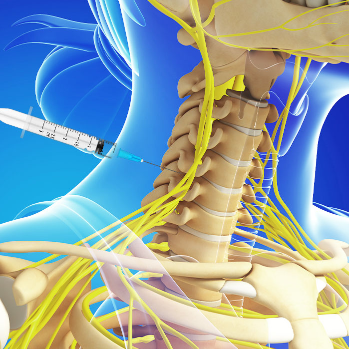 cervical epidural steroid injections in Coppell