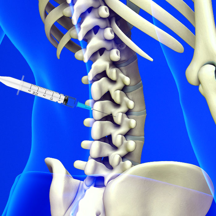 facet joint injections in Coppell