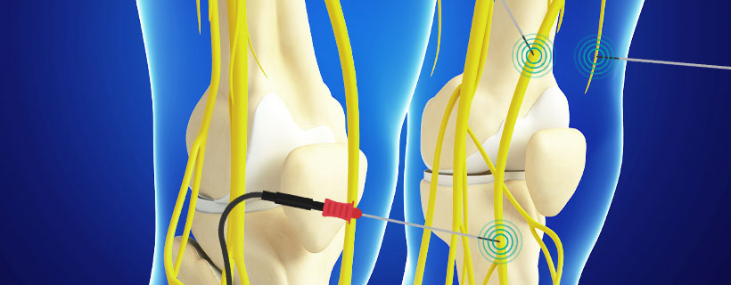 patient receiving Genicular Nerve Ablation in Coppell for auto accident injury pain relief