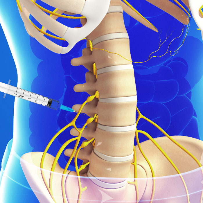 lumbar transforaminal epidural steroid injections in Coppell