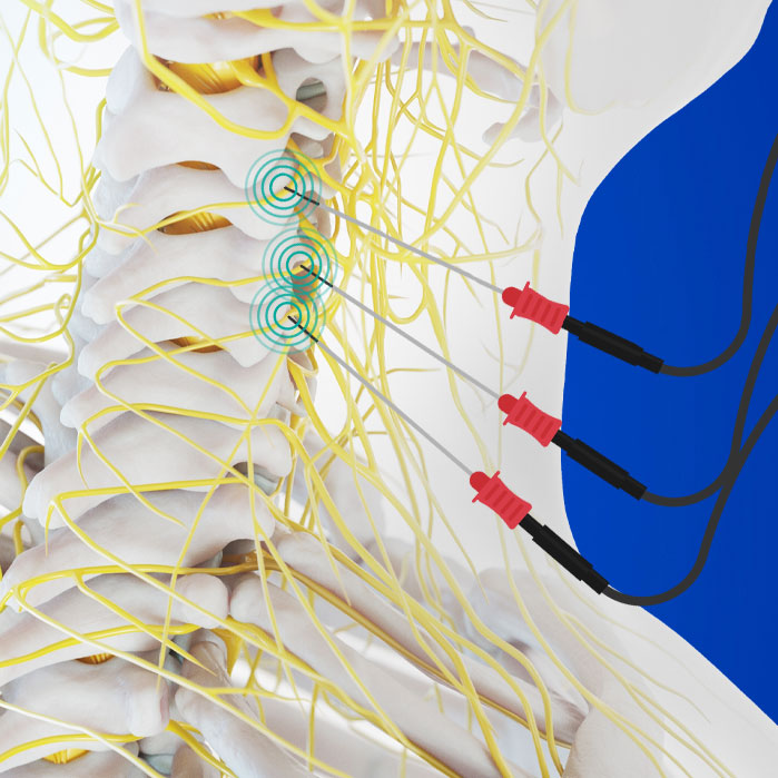 radiofrequency neurotomy in Coppell