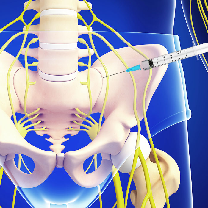 sacroiliac joint steroid injections in Coppell