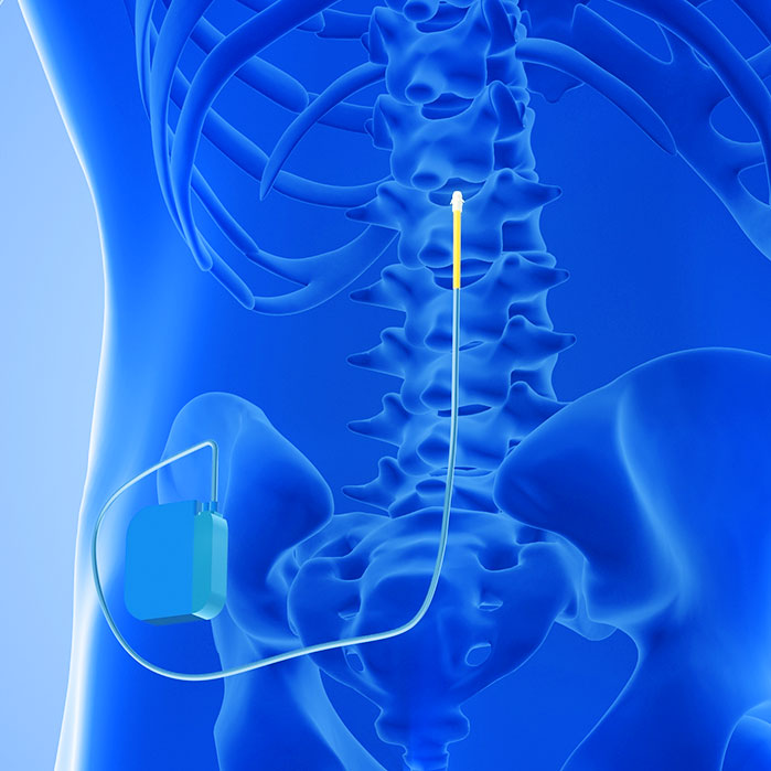 spinal cord stimulator implant in Coppell