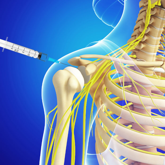 subacromial injections in Coppell