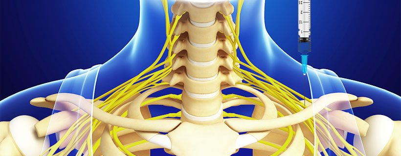 patient receiving Suprascapular Nerve Block in Coppell for auto accident injury pain relief