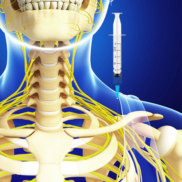 suprascapular nerve block in Coppell